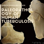 Paleopathology of human tuberculosis: review and focus on the hypothetical oldest evidence on the Homo erectus from Turkey